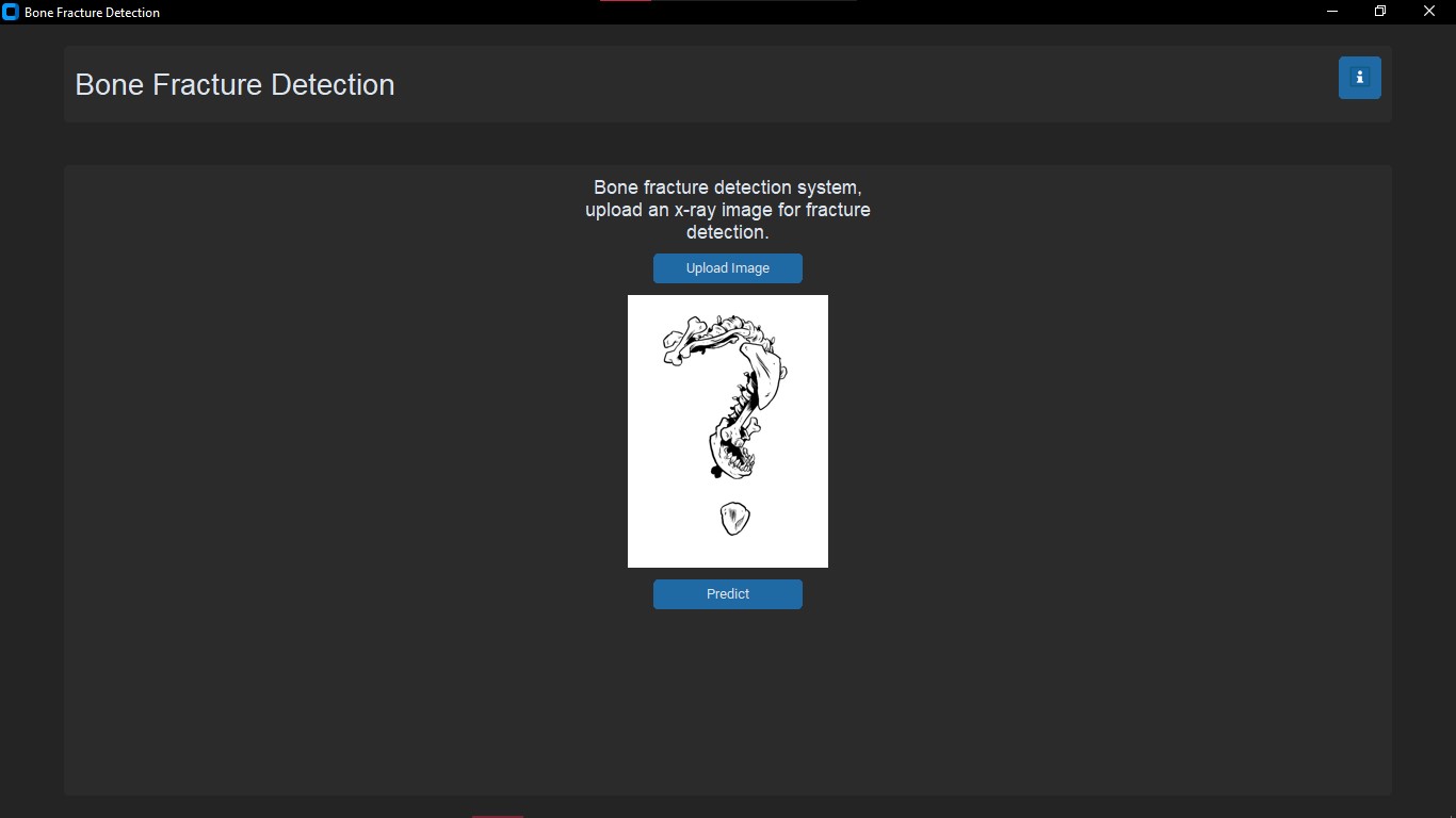 Bone Fracture Detection And Classification Using Deep Learning Approach